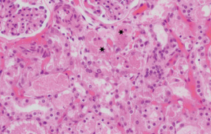 ブドウ中毒の腎臓: 尿細管の管腔には、脱落して壊死した上皮細胞 (星状) と混合した好酸球性のタンパク質性物質が含まれています。 HE染色、×400